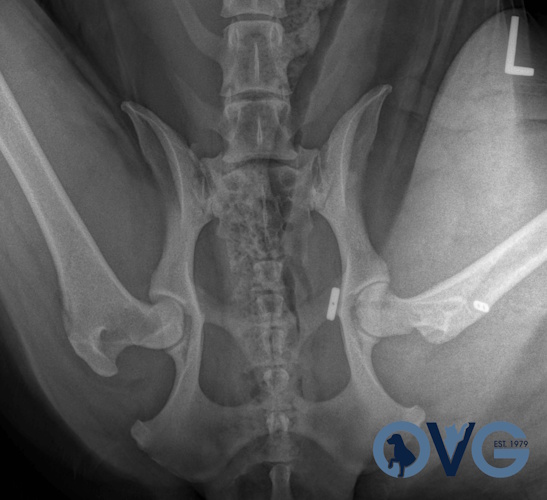 Post-op hip dislocation