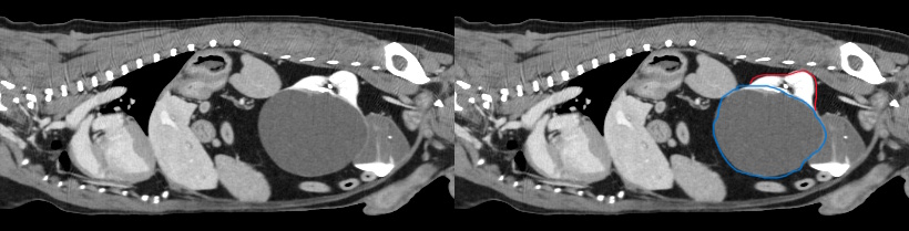 Cystic Kidney found on a CT scan
