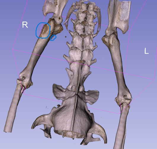 Marked osteosarcoma of the proximal humerus.