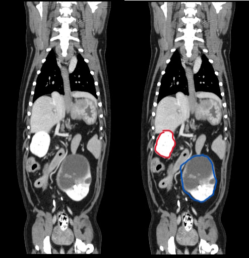 Normal right kidney (red), Abnormal left kidney with cyst (blue)