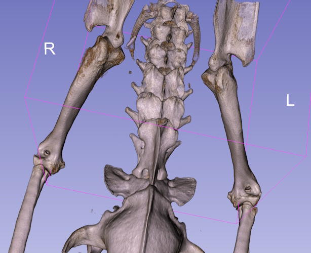 Osteosarcoma of the proximal humerus
