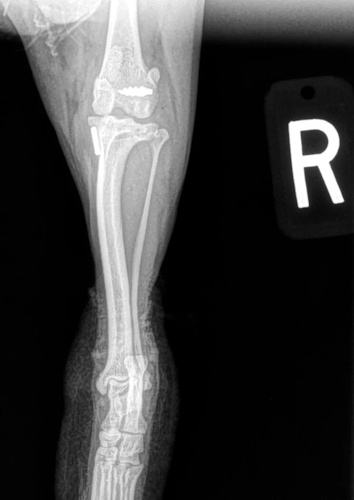 Post surgical caudocranial FASTak