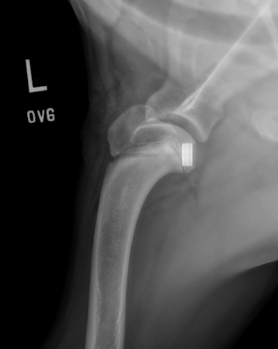 Shoulder Osteochondritis Dissecans (OCD) with a SynaCart Implant