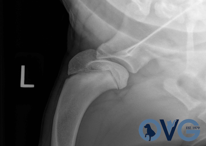 Shoulder Osteochondritis Dissecans (OCD)
